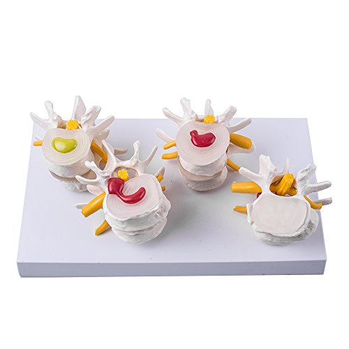 image for Zorvo 4-Part Anatomical Human Lumbar Vertebrae Degenerative Lumbar dis