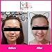 PRETTYVOL V Line Face Lifting Mask, Chin Up Patch Facial Mask for Tightening and Firming Skin, Moisturizing and Smoothening V Shape Tape and Double Chin Reducer, Pack of 5