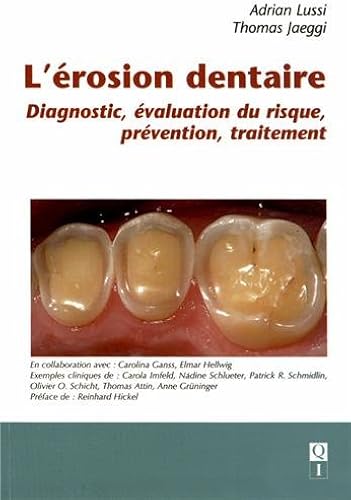 Download L'érosion dentaire : Diagnostic, évaluation du risque, prévention, traitement PDF
