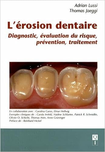 L Erosion Dentaire Diagnostic Evaluation Du Risque Prevention Traitement 9782366150056 Amazon Com Books