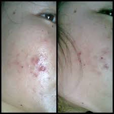 PRIM PERFECT HERBAL ACNE GEL POOMPUKSA 15