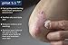 Psoriasis Cream (8 oz) - Best Psoriasis Treatment Cream - Relieve Symptoms Like Redness, Dry Patches, Plaque, Scales, Flakes by pHat 5.5