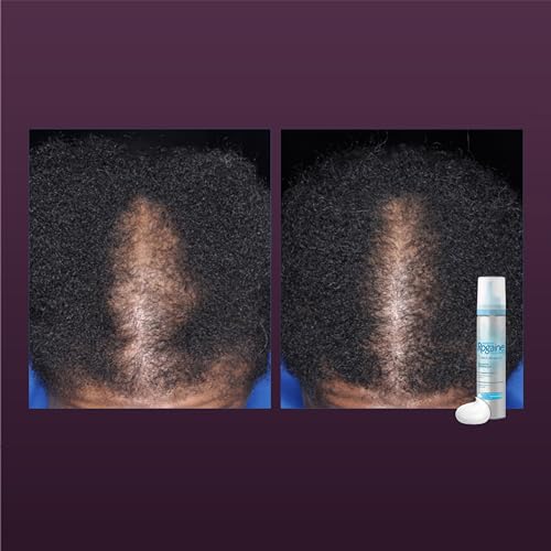 Rogaine Women's 5 Minoxidil Foam for Thinning Hair & Loss, Topical OnceADay Hair Fall