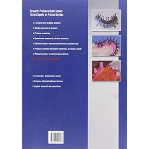 Prótesis sobre implantes