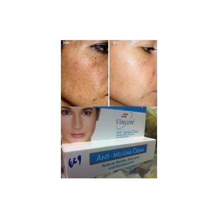 best sun spot removal cream