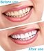 3 PCS Teeth Whitening Pen - Upgrade Gel Teeth Whitener Kit with Safe 35% Carbamide Peroxide Gel, No Sensitivity
