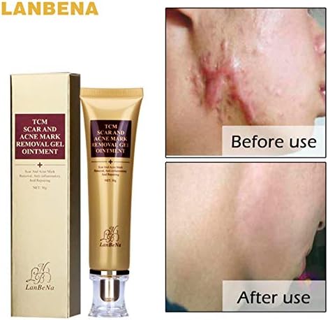 wowobjects Lanbena Acne Removal Of Scar Cream Skin Repair Facial Cream Acne Spots Acne Treatment Blackhead Whitening Stretch Mark Cream 30M