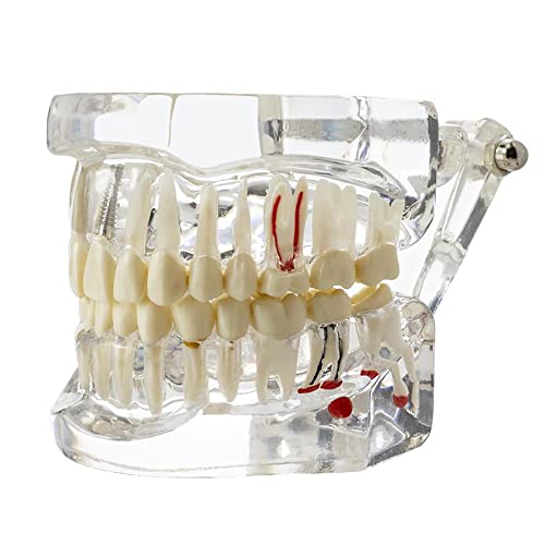 Dentalmall Dental Oral Typodont Model Implant Pathological Removable