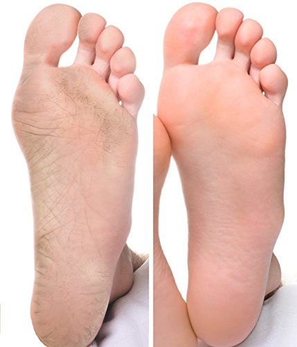 Dr. Foot Callus Cream with Urea, Jojoba Oil, Lactic Acid, Vitamin E. Exfoliating cream to soften dry, cracked calluses. 8oz tube.