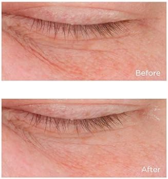 cold plasma eye perricone md