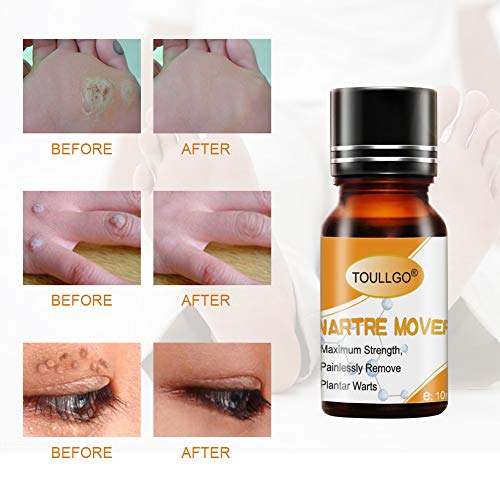 Plantar Wart Remover, Wart Removal, Salicylic Acid Wart Removal, Maximum Strength, Painlessly Remove Plantar Warts, Stops Wart Regrowth, 10ml