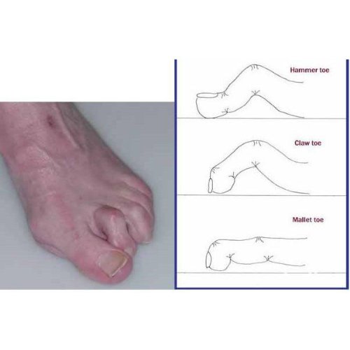 Right Foot Triple Toes Straightener Hammer Crooked Overlapping Toe Good quality