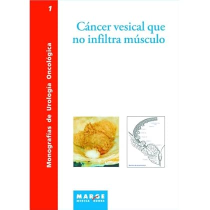 Cáncer vesical que no infiltra músculo
