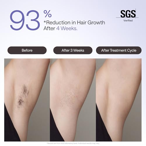 Ulike Laser Hair Removal Device Air 4 Ipl Gift for Women and Men, Ice Cool and Permanent Hair Reduction for Nearly Painless, USHR Mode Hair Removal in 10mins from Home