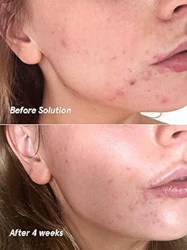 glossier chemical exfoliant