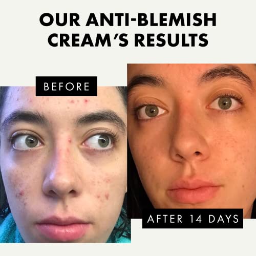Acne Cream for Spot Prone Skin Anti Blemish Face Moisturiser for