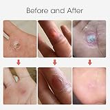 MQUPIN Corn Remover Pads 24 Pcs Foot Corn Plaster with Hole view 8