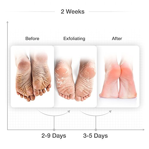 Foot Peel Mask, Antifungal Exfoliating Foot Mask for Dry and Dead Skin, Rebirth of Baby Soft Foot in a Week, Must-have Foot Callus Remover, Lavender Scented, 1 Pair
