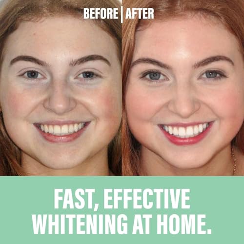 Spotlight Oral Care Teeth Whitening Strips – 28 Strips + Toothpaste (14-Day Treatment),Ultra Whitening Strips, Sensitive Teeth & Enamel Safe, Made by Dentists Hydrogen Peroxide Teeth Brightening Kit