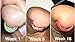 Antifungal Natural Treatment System Solution Kit (3 Piece) - Treats Toenail Fungus, Nail Fungus, and Discolored Nails.