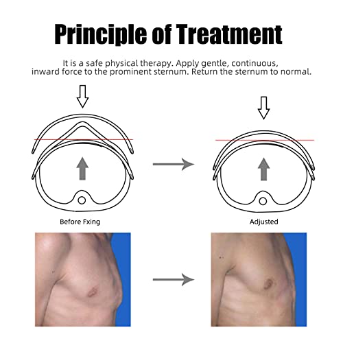 Tairibousy Kids Pectus Carinatum Orthosis Brace For Child Toddler