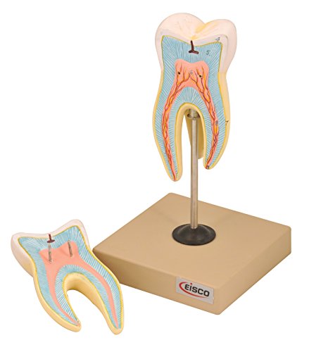 EISCO Upper Triple Root Molar with Caries Model, Enlarged 15 Times, 2 Parts, Hand Painted