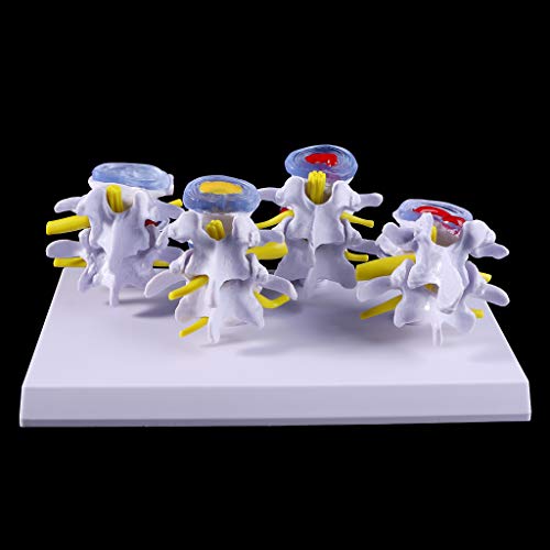 Abicial 1 Set Human Lumbar Lesion Spine Statue Display Model Medical Teaching Learning Tool