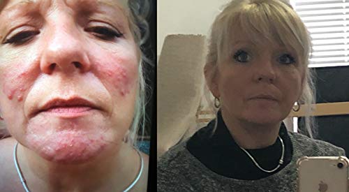 3 Exposed+Skin+Care+Treatment+Formulated