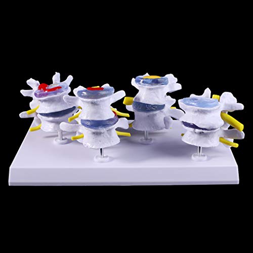 Abicial 1 Set Human Lumbar Lesion Spine Statue Display Model Medical Teaching Learning Tool
