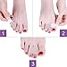 CHOLJ Toe Splint Wraps Pack of 8 Non Slip Hammer Toe Straightener for Broken, Crooked, Overlapped, and Hammer Toes-Women and Men