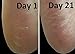 Foot Repair Serum - Eliminates Dry, Cracked Heels Fast! More concentrated than any creams, heel sticks or lotions!