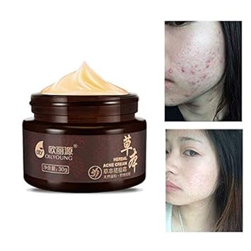 pimple and blackhead remover cream