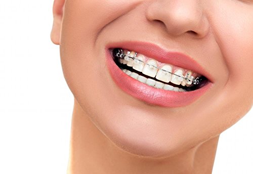 Wallmonkeys Closeup Beautiful Female Smile with Ceramic and Braces on Teeth Peel and Stick Wall Decals WM359293 (24 in W x 17 in H)