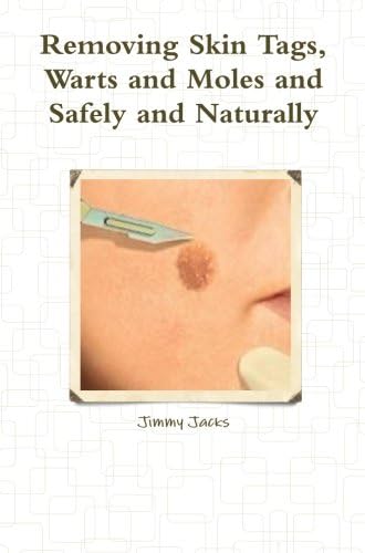 Removing skin tags, warts and moles and safely and naturally Paperback – April 14, 2013