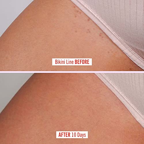 First Aid Beauty Ingrown Hair Pads with BHA & AHA Daily Treatment Relieves Razor Burn