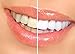 Smilebriter Teeth Whitening Gel Pens, 2 Pens :: No Peg, PPG, Artificial Flavors, or GMOs :: Gentle on Sensitive Teeth, Organic Ingredients :: Supports Dental Health, Mint Flavor