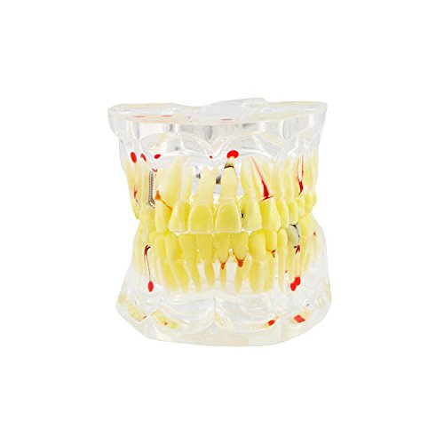Doc.Royal Dental Teeth Study Model Classic Implant Model with Restoration - Thumbnail 5
