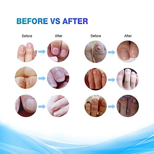 5 Toenail+Fungus+Fingernail+Remover+Solution