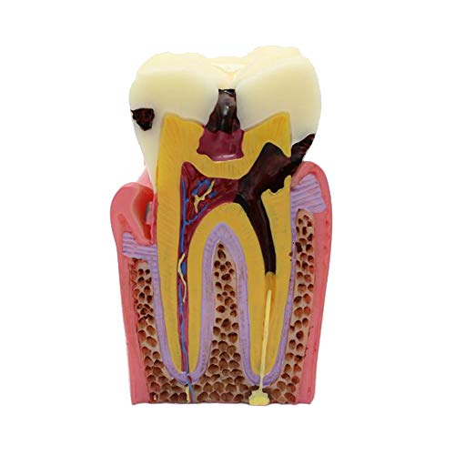 6 Times Caries Contrast Oral Model, Teeth Teaching Models for Research, Use for Patient Communication