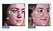 Omiera Adroit Natural Facial, Body, Bikini, And Legs Hair Growth Inhibitor Cream and Acdue Acne Scar Removal Cream, Severe Acne Spot Treatment, Acne Dark Spot Corrector Kit