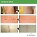 Puriderma Medical Silicone Scar Removal Extra Large Sheets [5.9''x1.57''] - Fast & Effective on Keloid, Surgery, Burn, Acne, C-Section Scars, 4 Reusable pcs