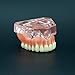 Dentalmall 1 Pc Dental Model #6001 01 - Overdenture Superior with 4 Implants Demo Model