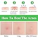 Acne Patch, BREYLEE Acne Treatment Tea Tree Acne Dots Acne Absorbing Cover Pimple Healing Sticker Blemish Spot Treatment Hydrocolloid Acne Patch (22 Count)