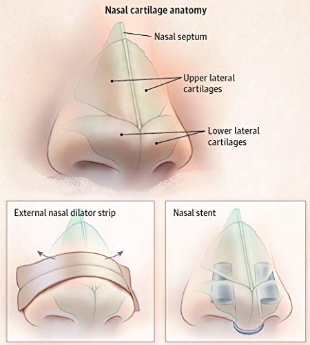 SleepWell Pro Stop Snoring Solution Nose Vent Devices Set - Thumbnail 3