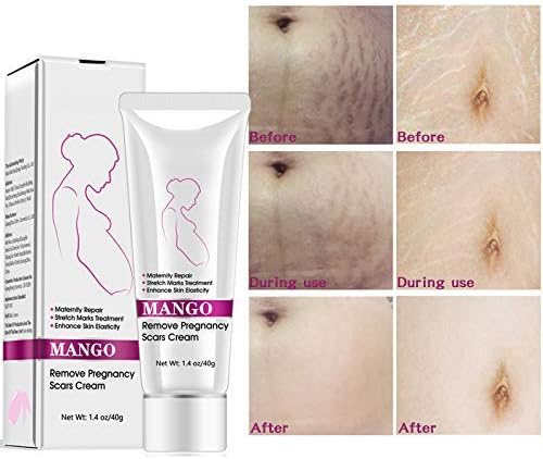 stretch marks cream for girl