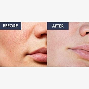 biobare vitamin c serum amazon