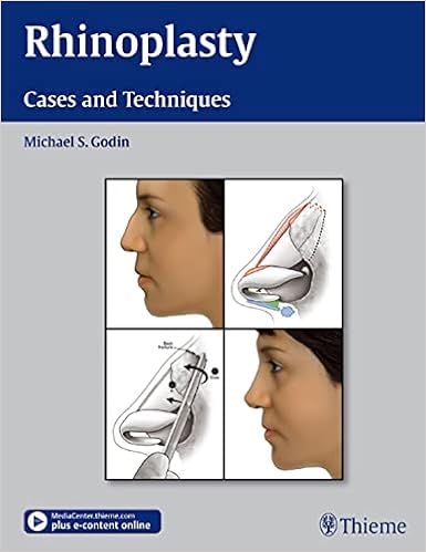 Amazon Rhinoplasty Cases And Techniques Godin Michael S M D Otolaryngology Amazon Rhinoplasty Cases And Techniques Godin Michael S M D Otolaryngology
