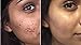 Amar Botanica Anti-Acne Daily Facial Treatment for Pregnancy | OBGYN Recommended | Vegan and Organic | Advanced AHA Formulation to Eliminate Hyper-Pigmentation, Rosacea and Cystic Acne