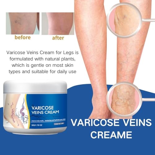 LBOYLOVE® 2 PCS Varicose Veins Cream for Legs, Spider Varicose Veins ReliefCream, SkinCream for Legs, Cream for VaricoseVeins