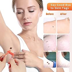 Painless Safe Skin Tag Remover Device Kit Micro